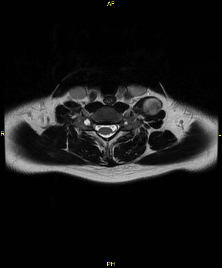 C5 nerve sheath tumor (Radiopaedia 85777-101596 Axial T2 56).jpg