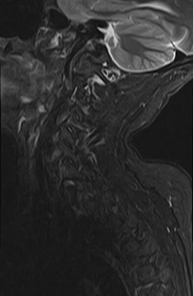 File:Calcified meningioma - cervical canal (Radiopaedia 70136-82468 Sagittal STIR 12).jpg