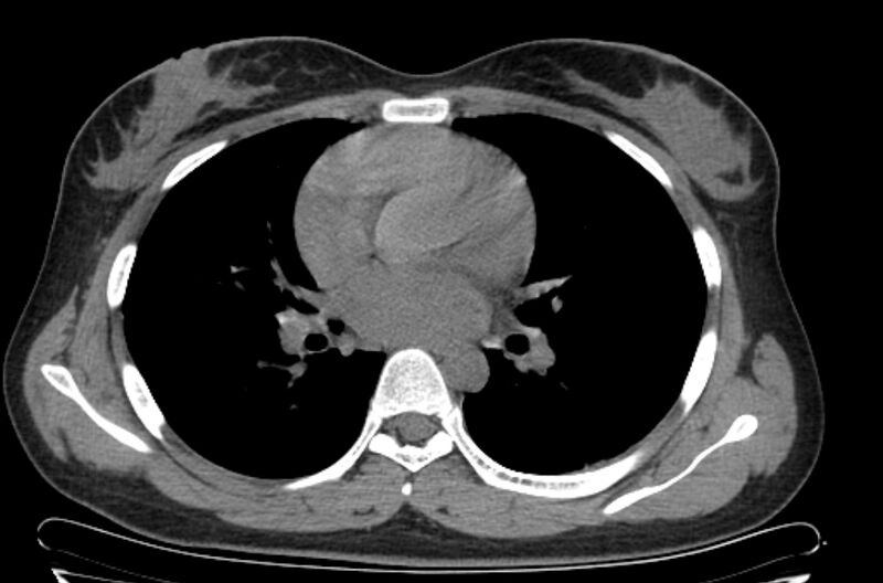File:Cannonball metastases - uterine choriocarcinoma (Radiopaedia 70137-80173 Axial non-contrast 59).jpg