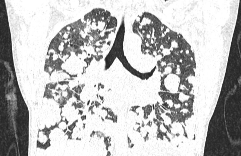 File:Cannonball metastases from breast cancer (Radiopaedia 91024-108569 Coronal lung window 84).jpg