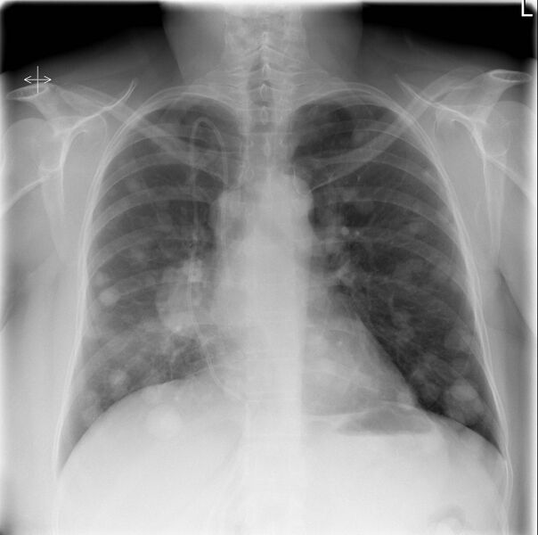 File:Canon-ball pulmonary metastases from breast cancer (Radiopaedia 6845).jpg
