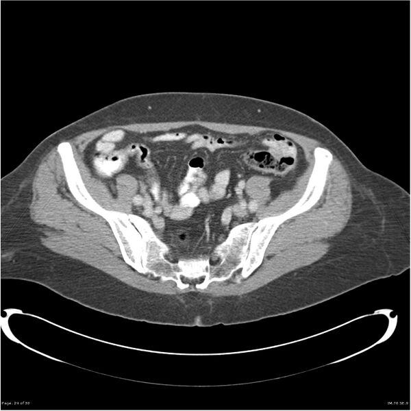File:Carcinoid tumor of the ileum with metastasis to orbit (Radiopaedia 28165-28425 A 24).jpg