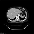 Carcinoma cervix- recurrence (Radiopaedia 34702-36137 B 10).jpg