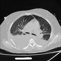 Cardiogenic pulmonary edema (Radiopaedia 29213-29609 Axial lung window 39).jpg