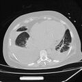 Cardiogenic pulmonary edema (Radiopaedia 29213-29609 Axial lung window 71).jpg