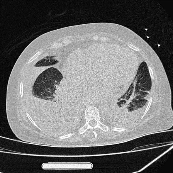 File:Cardiogenic pulmonary edema (Radiopaedia 29213-29609 Axial lung window 71).jpg