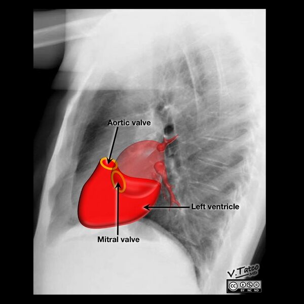 File:Cardiomediastinal anatomy on chest radiography (annotated images) (Radiopaedia 46331-50772 Q 6).jpeg