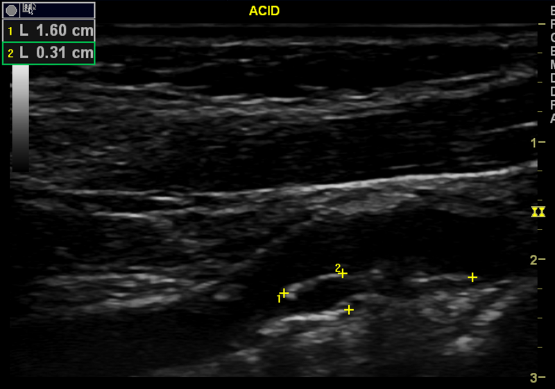 File:Carotid artery stenosis (Radiopaedia 28786-29088 D 1).png