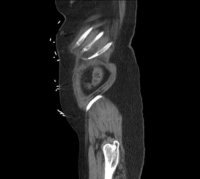 File:Celiac artery severe stenosis and dissection (Radiopaedia 44128-47842 A 4).jpg