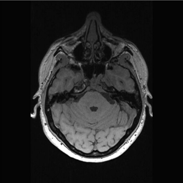 File:Central base of skull meningioma (Radiopaedia 53531-59549 Axial T1 8).jpg