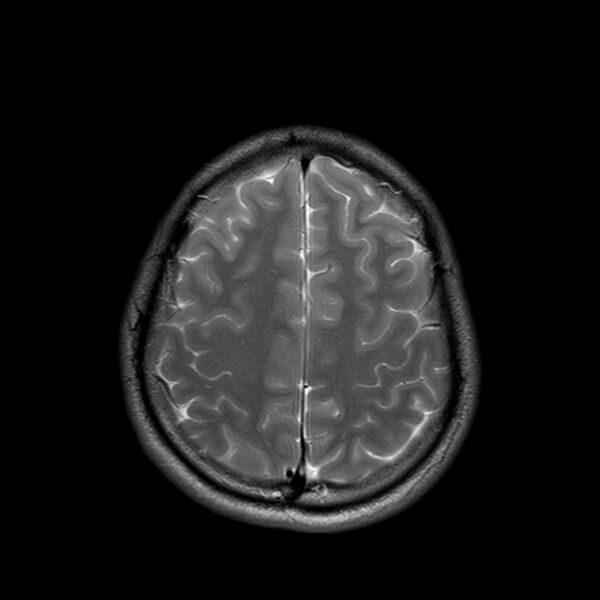 File:Central neurocytoma (Radiopaedia 79320-92380 Axial T2 22).jpg