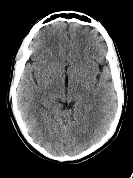 File:Cerebellar infarct due to vertebral artery dissection with posterior fossa decompression (Radiopaedia 82779-97032 Axial non-contrast 13).png