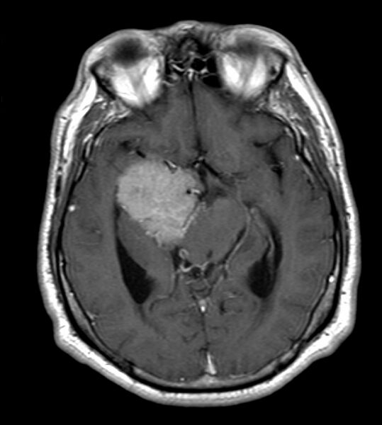 File:Cerebellopontine angle meningioma (Radiopaedia 24459-24764 Axial T1 C+ 11).jpg