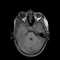 Cerebral abscess post cardiac surgery (Radiopaedia 27244-27420 Axial T1 7).jpg