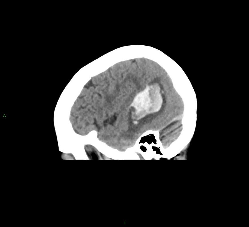 Cerebral amyloid angiopathy-associated lobar intracerebral hemorrhage (Radiopaedia 58378-65516 C 11).jpg