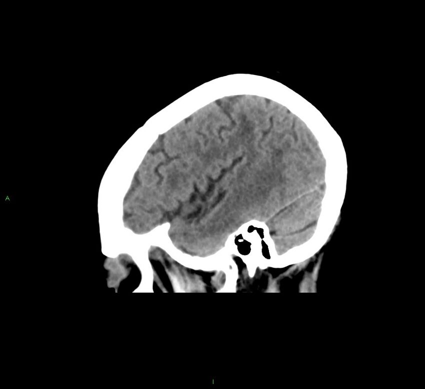 Cerebral amyloid angiopathy-associated lobar intracerebral hemorrhage (Radiopaedia 58378-65516 C 40).jpg