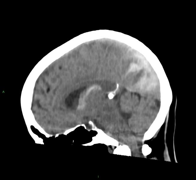 File:Cerebral amyloid angiopathy-associated lobar intracerebral hemorrhage (Radiopaedia 58754-65975 C 24).jpg