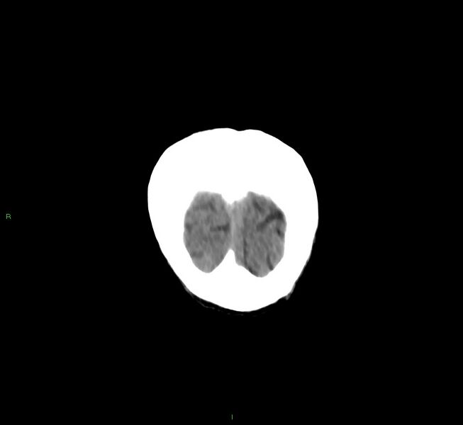 File:Cerebral amyloid angiopathy-associated lobar intracerebral hemorrhage (Radiopaedia 58758-65980 Coronal non-contrast 6).jpg