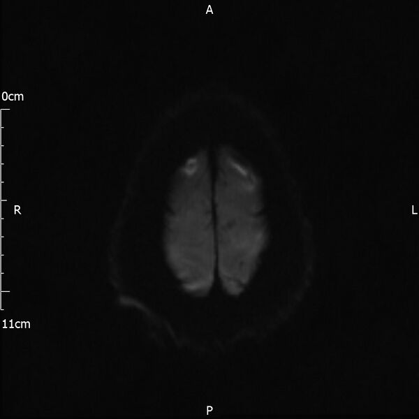 File:Cerebral amyloid angiopathy related inflammation (Radiopaedia 72772-83415 Axial DWI 45).jpg