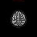 Cerebral and orbital tuberculomas (Radiopaedia 13308-13311 Axial T2 18).jpg