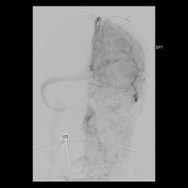 File:Cerebral arteriovenous malformation with lobar hemorrhage (Radiopaedia 44725-48513 LT CCA IC 18).png