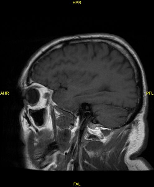 File:Cerebral autosomal dominant arteriopathy with subcortical infarcts and leukoencephalopathy (CADASIL) (Radiopaedia 86108-102054 Sagittal T1 8).jpg