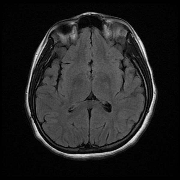 File:Cerebral cavernous malformation (Radiopaedia 44301-47942 Axial FLAIR 11).jpg