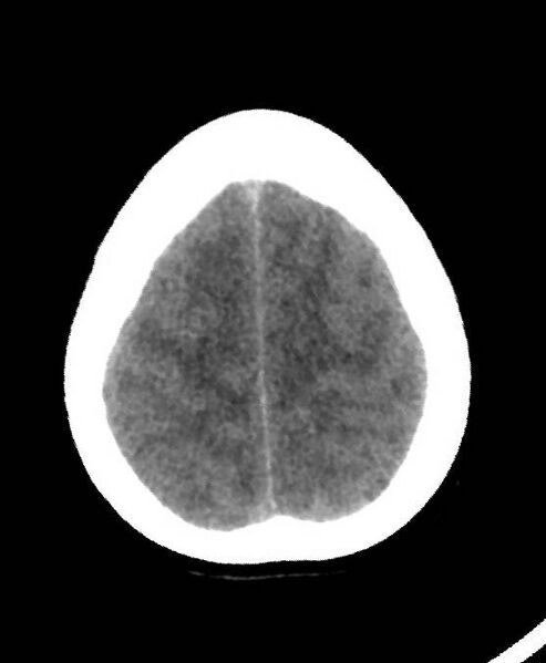 File:Cerebral edema due to severe hyponatremia (Radiopaedia 89826-106937 Axial non-contrast 79).jpg