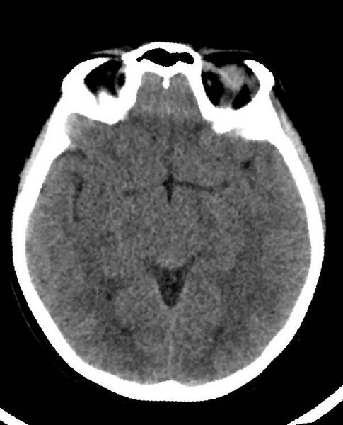 File:Cerebral edema due to severe hyponatremia (Radiopaedia 89826-106938 Axial non-contrast 47).jpg