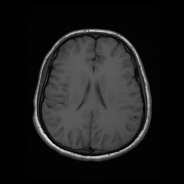 File:Cerebral fat embolism (Radiopaedia 37510-39363 Axial T1 17).jpg