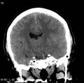 Cerebral hemorrhagic contusion with subdural and subarachnoid hemorrhage (Radiopaedia 10680-11146 Coronal non-contrast 10).jpg