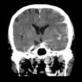 Cerebral hemorrhagic contusions (Radiopaedia 23145-23188 Coronal non-contrast 20).jpg