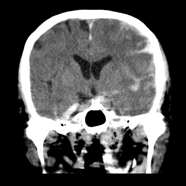 File:Cerebral hemorrhagic contusions (Radiopaedia 23145-23188 Coronal non-contrast 20).jpg