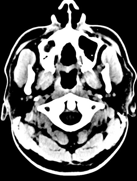 File:Cerebral venous angioma (Radiopaedia 69959-79977 Axial non-contrast 2).jpg