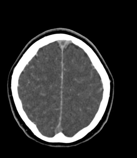 File:Cerebral venous sinus thrombosis (Radiopaedia 59224-66646 Axial C+ delayed 11).jpg