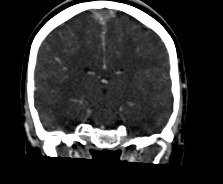 File:Cerebral venous sinus thrombosis (Radiopaedia 59224-66646 Coronal C+ delayed 41).jpg