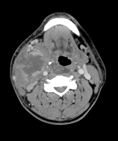 File:Cervical abscess (Radiopaedia 43725-47184 A 33).png