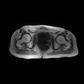Cervical carcinoma (Radiopaedia 78847-91705 Axial T1 13).jpg