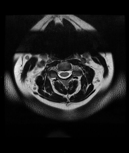 File:Cervical disc prolapse (Radiopaedia 80258-93598 Axial T2 5).jpg
