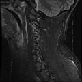 Cervical flexion teardrop fracture with cord hemorrhage (Radiopaedia 32497-33455 Sagittal STIR 4).jpg
