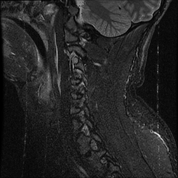 File:Cervical flexion teardrop fracture with cord hemorrhage (Radiopaedia 32497-33455 Sagittal STIR 4).jpg