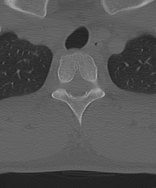 File:Cervical intercalary bone (Radiopaedia 35211-36748 Axial bone window 66).png