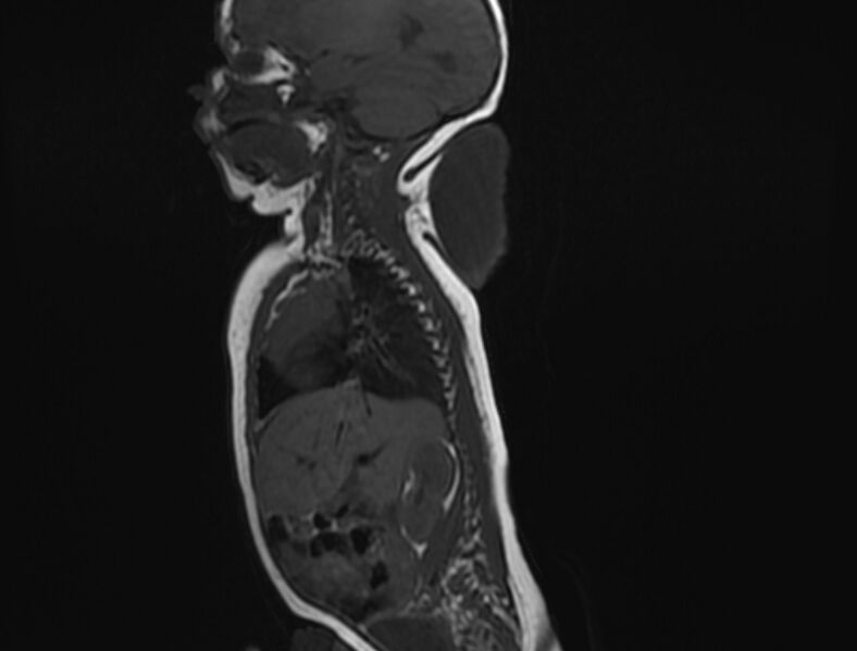 File:Cervical myelomeningocele (Radiopaedia 69569-79479 Sagittal T1 3).jpg