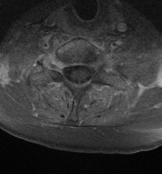 File:Cervical spondylodiscitis (Radiopaedia 81362-95110 Axial T1 C+ fat sat 15).jpg