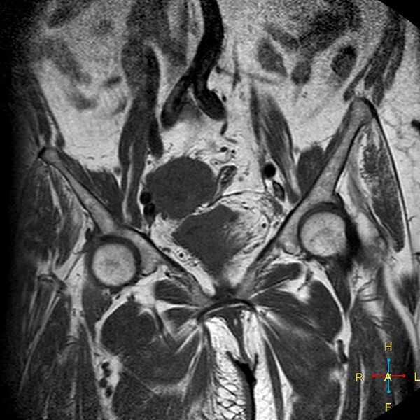 File:Cervical stump squamous cell carcinoma (Radiopaedia 48049-52858 Coronal T1 5).jpg