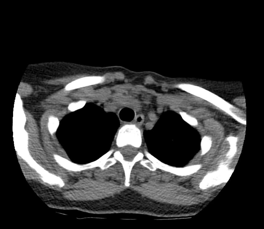 Cervical venous malformation (Radiopaedia 22653-22672 Axial non-contrast 52).jpg