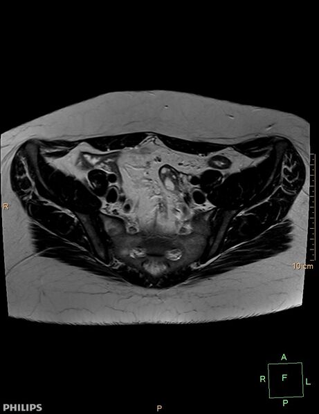 File:Cesarian scar endometriosis (Radiopaedia 68495-78066 Axial T2 5).jpg
