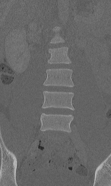 File:Chance fracture (Radiopaedia 40360-42912 Coronal bone window 21).png