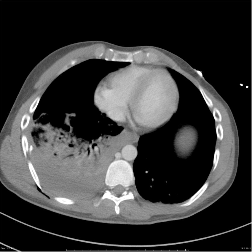 Chest and abdomen multi-trauma (Radiopaedia 26294-26426 bone window 7).jpg