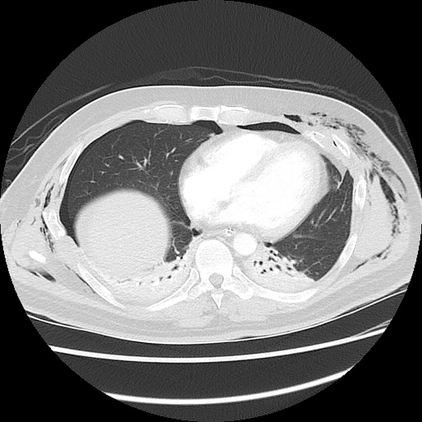 Chest crush injury (Radiopaedia 31620-32513 Axial lung window 38).jpg